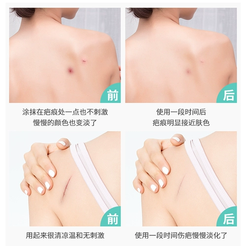 修正 Шрад остановился, шрамы лиц восстанавливают Scald Scald и гиперплазию подлинную подлинную подлинную