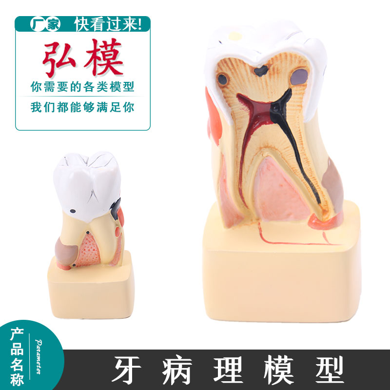 牙体病理模型牙解剖模型牙齿模型龋齿牙龈牙科室内展示牙护理模具
