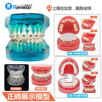 Dental self-locking bracket orthodontic dental model ceramic bracket metal bracket self-locking bracket comparative model