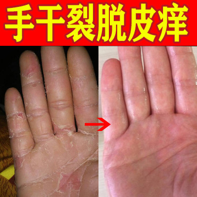 Protective Hand Cream Hand Cracked Dry Rough Cracks Peeling Skin Cream Hand Tender Skin Cracking Finger Cleft Non Repair Cream