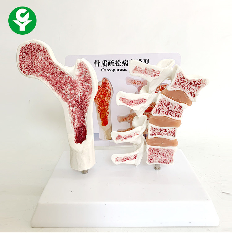 人体股骨骨质疏松解剖模型腿骨解剖面脊柱切面标本病变腰椎模型