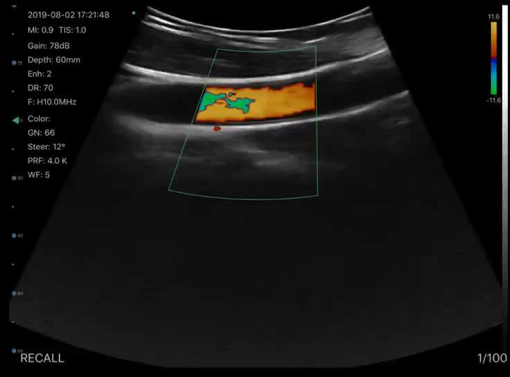 3 In 1 Color Doppler 128 Elements Portable Ultrasound,Linear&convex