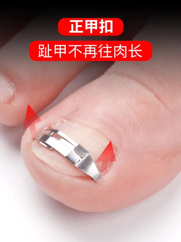 Ingrown Toenail Tools Set Include Toe Nail Correction Buckle Patch Tape