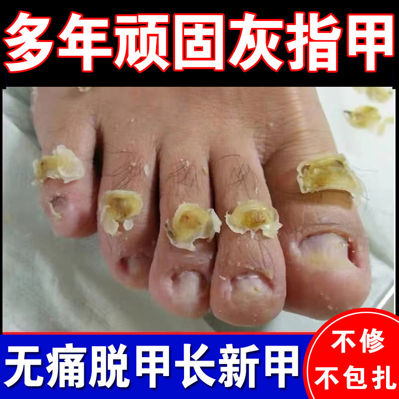Nail Removal Cream for Onychomycosis, Thickening and Yellowing of Toenails, Quick Nail Removal, Painless Antibacterial Liquid, Special Toenail Softener Nail Removal Cream for Onychomycosis, Thickening and Yellowing of Toenails, Quick Nail Removal, Painless Antibacterial Liquid, Special Toenail Softener