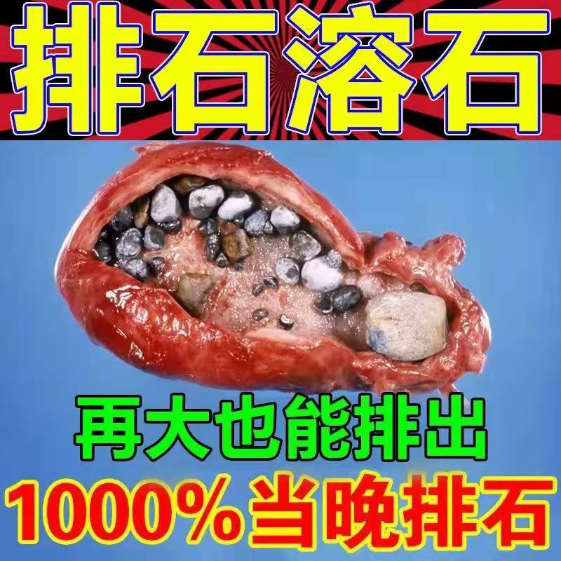 Gallstones Soluble Stone Fossilized special appliuria Powerful Drain Remove Urinary Tract Crushed gallbladder Gallbladder Inflammation of Pulp Plasters Paste