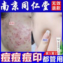 Aloe Vera Gel Acne Print Pimple Pit Repair To Pimple Pimple Pimple Acne Scar Gel Desalinated Cream for men and women