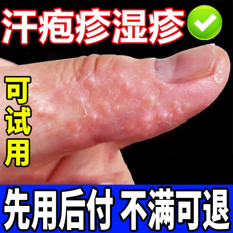 Sweat Blisters and Rash Ointment to Relieve Itching and Remove Small Blisters on Hands, Imported Special Ointment for Fungal Infection and Peeling Skin Sweat Blisters and Rash Ointment to Relieve Itching and Remove Small Blisters on Hands, Imported Special Ointment for Fungal Infection and Peeling Skin
