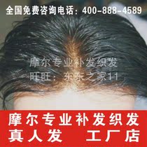 Moore hair replacement Premium quality needle delivery Invisible incognito hair line Swiss bionic film hair repair hair increase hair