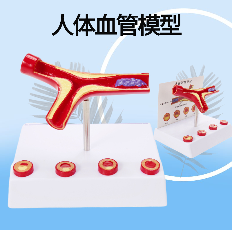 Clogged blood vessel blood concentration Fatty Pathology Blood Vessel Porridge-Like Human Vascular Pathology Anatomical Model