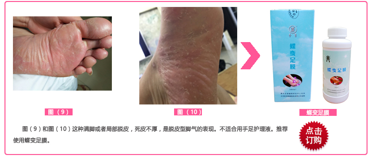 Tẩy tế bào chết bộ phim chân phim chết da ông già tay thanh chống khô chăm sóc bàn chân thiết lập nhà sửa chữa gót chân mà không lột kem trị nứt nẻ chân tay