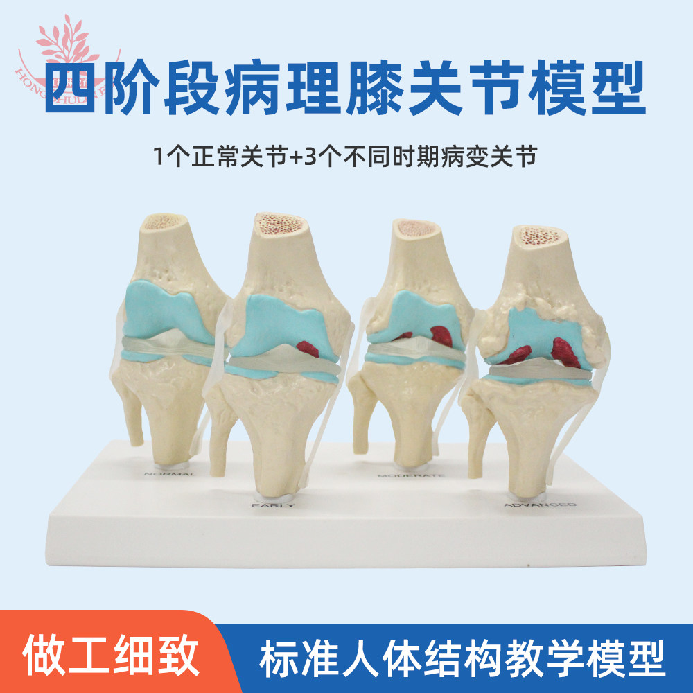 人体四阶段病理膝关节模型等比还原轻微到严重医用人体病变膝盖骨