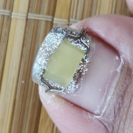 Ingrown Toenail Corrector, Nail Correction Stickers, Nail Correction Clips, Nail Correction Device, Ingrown Toenail Correction Patches, Nail Correction Ingrown Toenail Corrector, Nail Correction Stickers, Nail Correction Clips, Nail Correction Device, Ingrown Toenail Correction Patches, Nail Correction