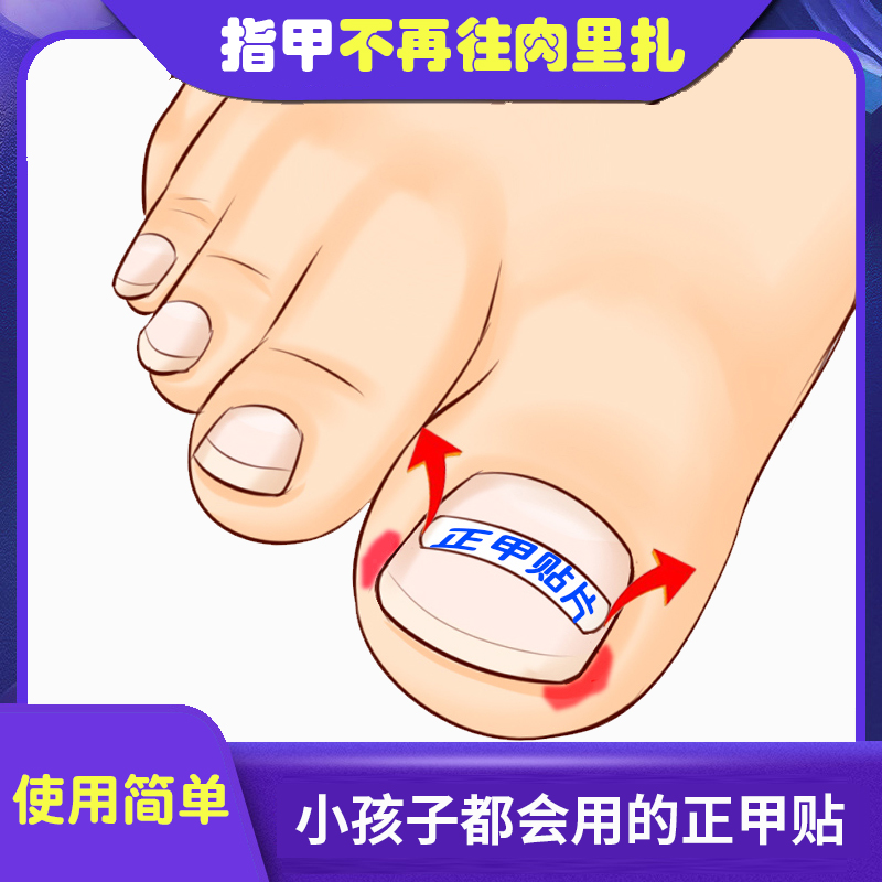 First pedicure nail groove inlaid nails to correct toenail long flesh in the nail sticker pull pull corrector patch inflammation and talent