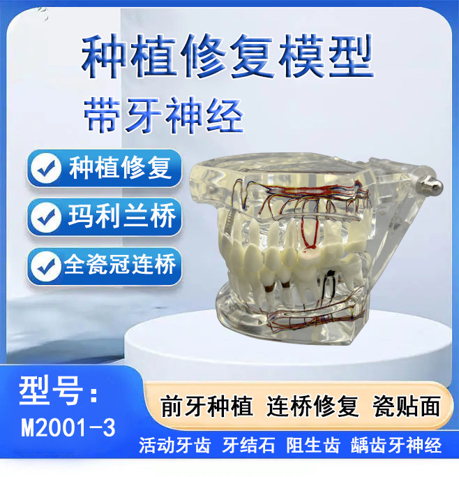 牙科全瓷冠瓷贴面 可拆卸种植体修复模型 活动牙种植牙阻生齿龋齿