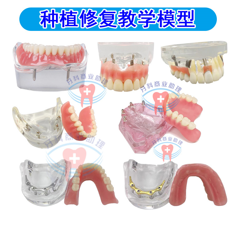 Dental Model, Oral Implant Model, Implant Explanation, Denture Restoration Comparison, Implant Screw, Ball Cap, Rod, Guide Plate