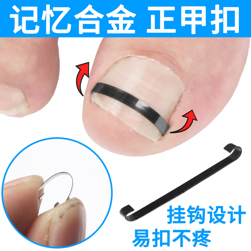 Upgraded Version of the Ingrown Toenail Correction Clip with Adjustable Tension to Correct Nails That Are Growing into the Flesh, Suitable for Both Men and Women