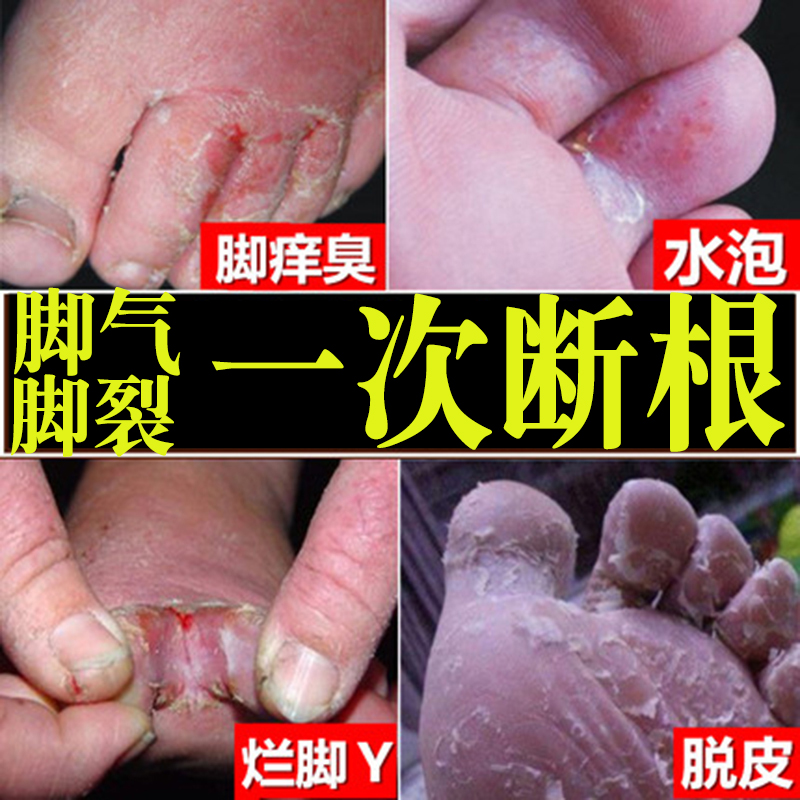 Foot-qi cured foot girl with feet and feet itching peeling water bubble stubborn heel dry Hong Kong paste to root special effects