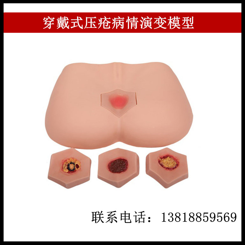 穿戴式压疮病情演变模型