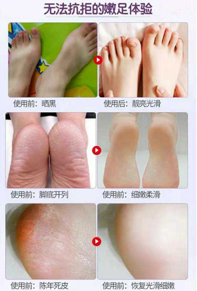 Mặt nạ dầu ngựa của Nhật Bản của Yun Yun đến da chết Ông già chân mềm gót chân khô nứt chân làm trắng dưỡng ẩm chăm sóc chân kem trị nứt gót