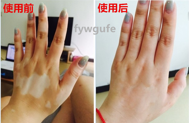 Đốm trắng kem che khuyết điểm sửa chữa vitiligo bao gồm chất lỏng không thấm nước loại nemesis kéo dài chính hãng da tại chỗ mặt melanin