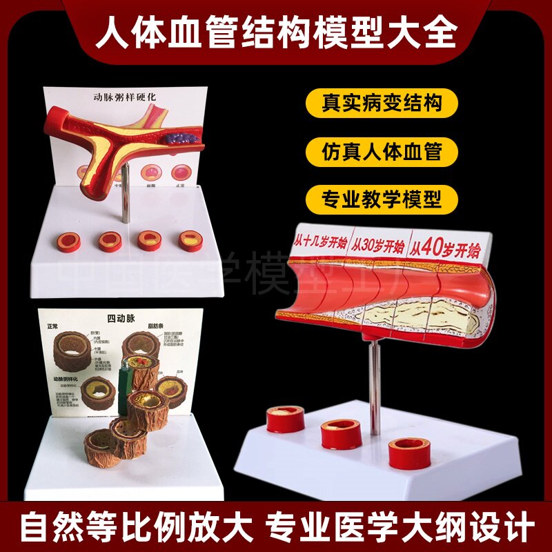 堵塞血管血液浓度脂肪病理血液血管粥样人体血管病理解剖血管模型