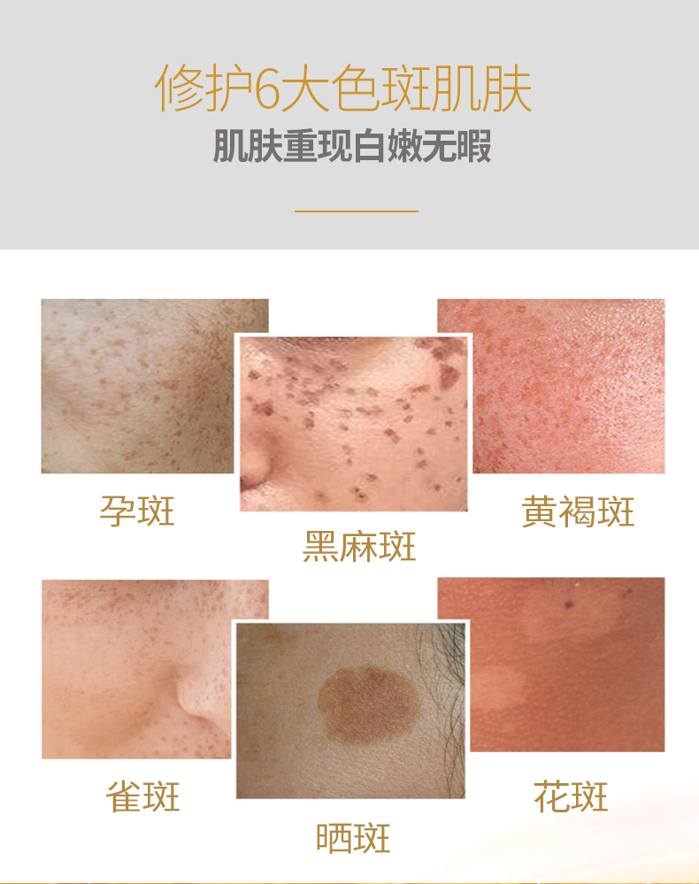 Lắc cùng một đoạn kem làm trắng tàn nhang chính hãng đốm mờ đốm tàn nhang sản phẩm kem đốm nước - Kem dưỡng da kem dưỡng da mặt tốt