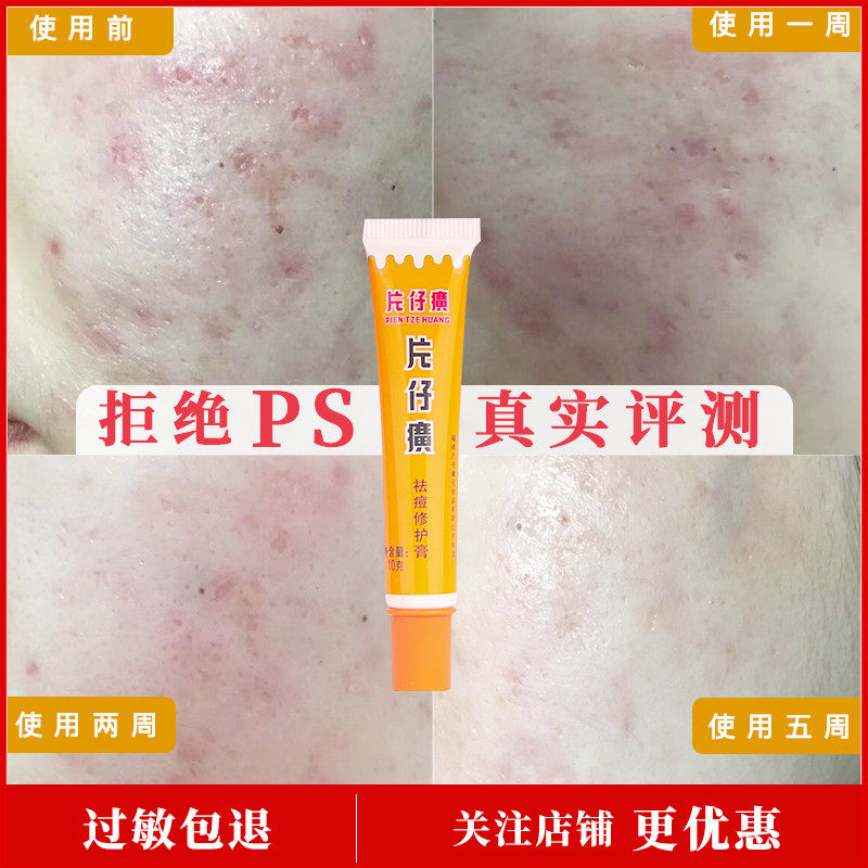 Clearance of the old Pien Tze Huang acne repair cream light acne print smooth uneven pore acne 10g