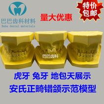 Dental Angles orthodontic misjaw gypsum display model 123 class misjaw dentition comparison model rabbit teeth cover the sky