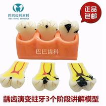 Dental Model Quadruple Dental Evolution Model Tooth Decay Demonstration Doctor-patient Communication Carious development Pathological Decomposition