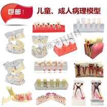 Dental Oral teaching model Tooth decay Caries development demonstration Crystal adult pathology model Dental anatomy display