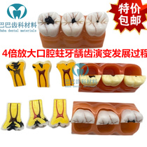 Dental oral four-fold caries decomposition model tooth decay demonstration dental caries development pathology doctor-patient communication
