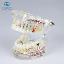 Dental oral teaching detachable implant restoration model active dental implant doctor-patient communication