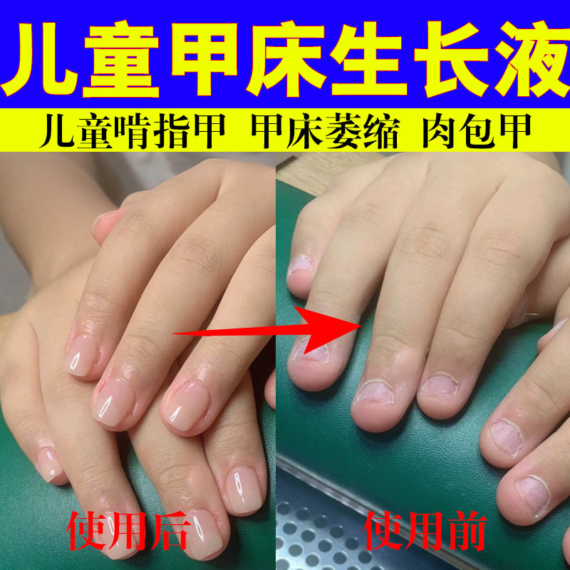 Children's Nail Growth Liquid for Short, Broken Nails, Nail Bed Recession, Biting, Hangnails, Layering, Malnutrition, Repair Oil Children's Nail Growth Liquid for Short, Broken Nails, Nail Bed Recession, Biting, Hangnails, Layering, Malnutrition, Repair Oil
