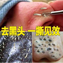 Removing blackheads acne shrinking pores Weiya Li Jiaqi recommends male and female aloe vera gel nose mud mask nose stickers