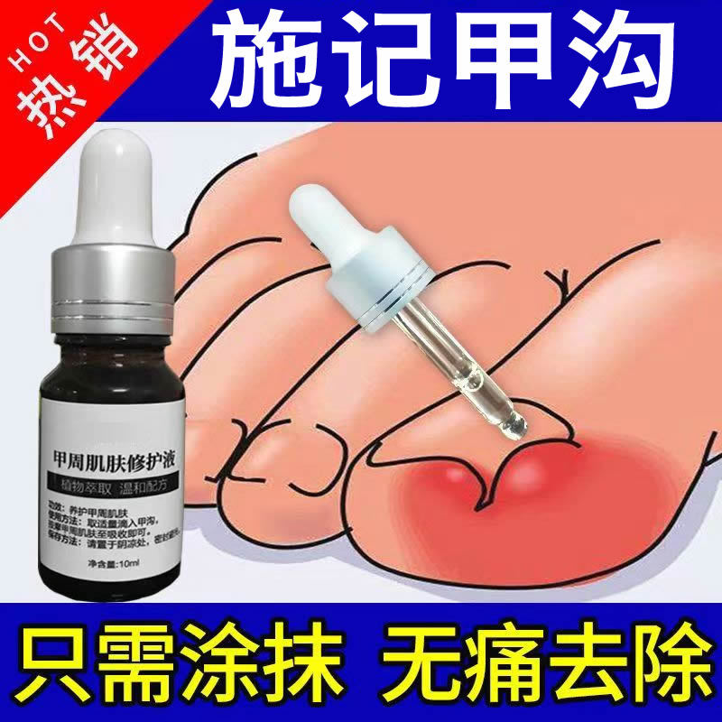 Shi's Jiaogou Kangqing Is a Special Product for Treating Nail Groove Inflammation, Redness, and Pain. Shi's Jiaogou Qing Is Specifically for Nail Groove Issues Shi's Jiaogou Kangqing Is a Special Product for Treating Nail Groove Inflammation, Redness, and Pain. Shi's Jiaogou Qing Is Specifically for Nail Groove Issues