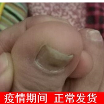 Li Guanghuas hands and feet gray fingers and toes nail and toe ringworm liquid original set sterilization nail removal thickening powder discoloration good