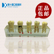 Oral Medical Teaching Aids Crystal Root Canal Treatment Model Tooth Neural Necrosis Cove can be removed to repair the tooth crown