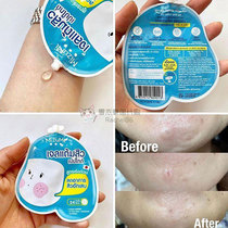 Thailands uppoompat Ke Zhihui endorses Mizumi mild formula to remove acne and dilute acne marks gel 4g