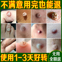 Special medicine for removing meat thorn monkeys to remove monkey meat pimples to treat scabs on feet and hands fish scales moles and warts