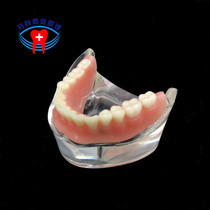 Dental implant repair model Half mouth implant nail ball cap combined with covered denture implant and repair teaching