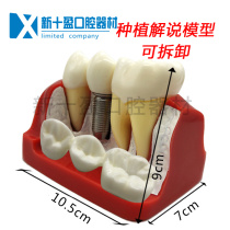 Dental 4x implant solution model denture repair Implant explanation Removable bridge crown implant nail