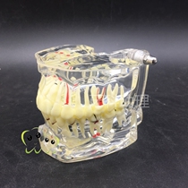 Dental Oral teaching model Adult pathology Crystal model Dental implant caries Wisdom tooth loss demonstration case