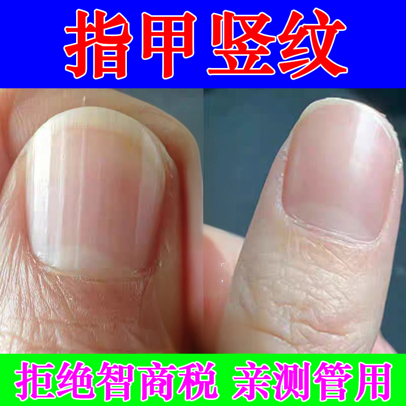 Nail Vertical Stripe Repair Solution for Nourishing Nail Beds, Separating Detached Nails, Treating Cracked and Damaged Nails, Addressing Peeling and Uneven Nails, Nail Care Oil