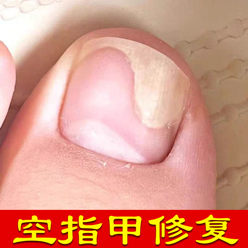 Nail Repair Solution for Damaged Nail Beds, Separation of Nail Flesh, Hollow Nails, Specialized Layered Nourishment, Growth, Treatment for Hands and Toes