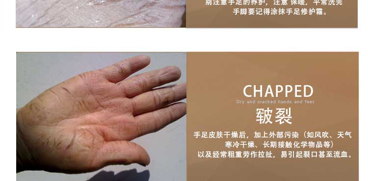 Mỡ ngựa, gót chân, nứt, chống nứt, nứt, nứt, tay, chân, chống nứt, bong tróc, chăm sóc chân, kem bôi tay kem ủ chà gót chân