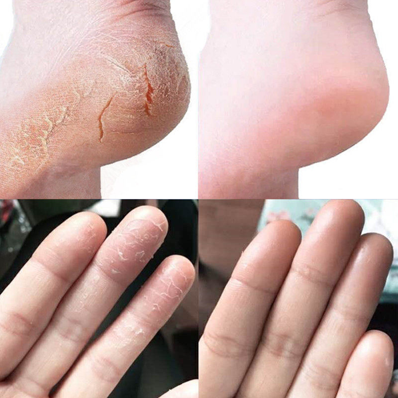 Hands and feet peeling seasonal finger cracking dry cracking dry crack rough crack anti-crack burst ancient extraction healing cream