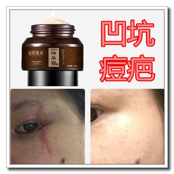 Fill a disrecessed scar Scar Cover God remove the front chest Youth pimple pimple acne Acne Scar Mask Downplay Repair Pimple Pit