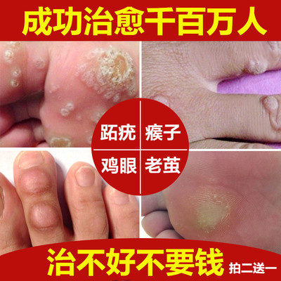 Removing thorn monkey corns to remove the root to remove the monkey's ointment wart to remove the hand meat pimple fish scale mole paste