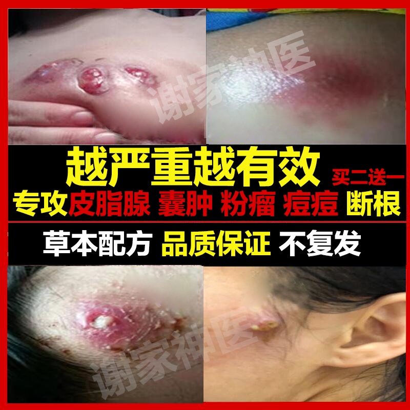 Sebaceous cyst ointment acne removal bartholin gland bartholin cyst detoxification ointment tendon sheath popliteal acne artifact