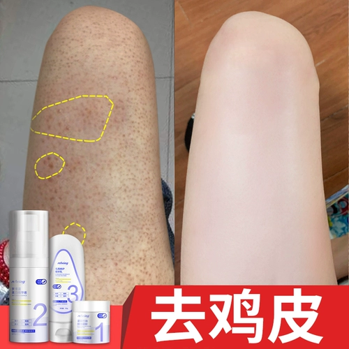 Перейти к куриной коже крикет волосы волосяной фолликул возбужденный кератинизация Удаление рыбных чешуйков